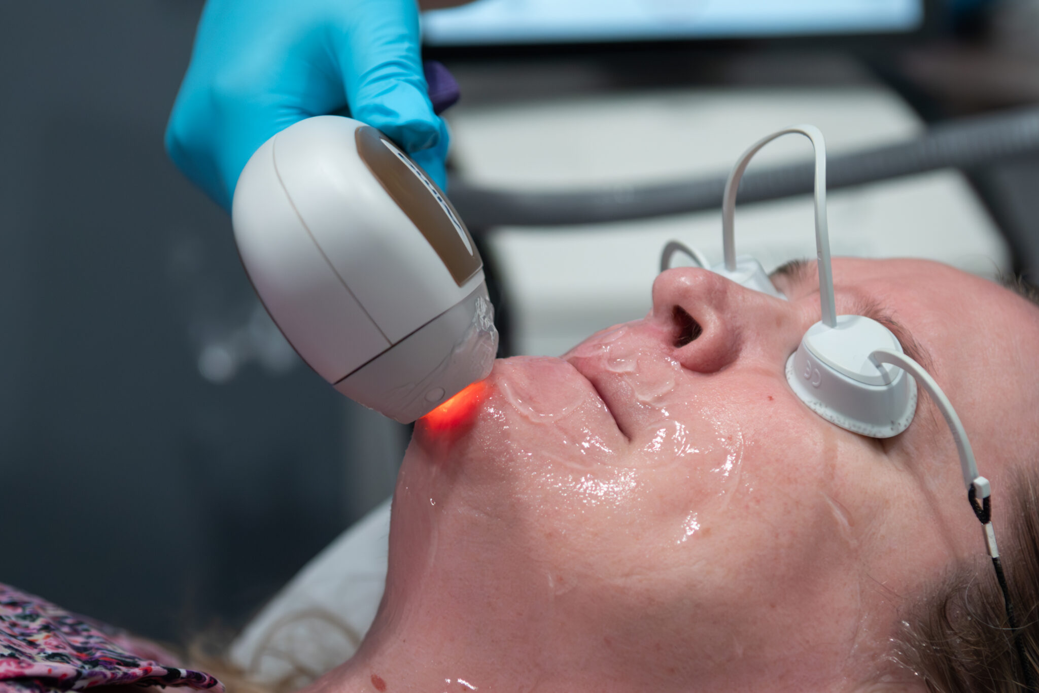 Laserhairremovalpatient